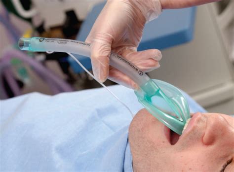 intubazione con maschera laringea